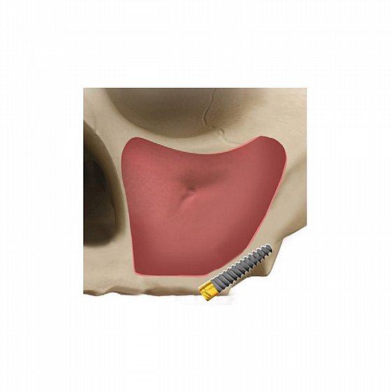��� ��������� ����� ����� ����� 3.3 �� ���� ������  JDPterygo One Pterygoid Implant