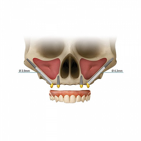 ��� ������� ?4.3 �"� ����� ����� ����� ���� ������  JD JDZygoma Implant
