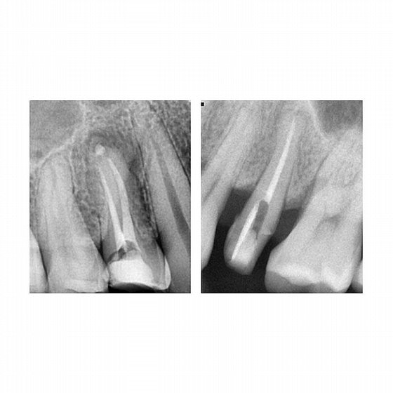 ���� ������ ��������� ����� 2 ��� Any-Paste� Temporary Root Canal Filling Material
