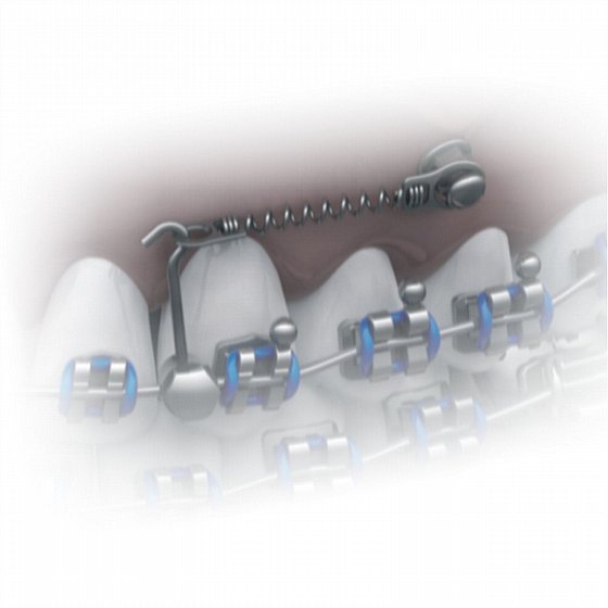 ���� ����� ���� 4 �� ����� 7/9/12 �"� Morelli CLOSED SPRING NiTi - EYELETS ?1,60mm