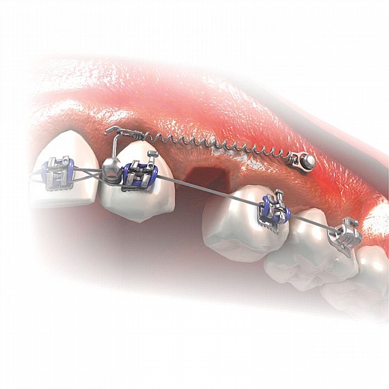 ���� ���� ���������� ������  ���� 1.5 - 2�� ����� ������ Morelli Orthodontic Mini Screw 
