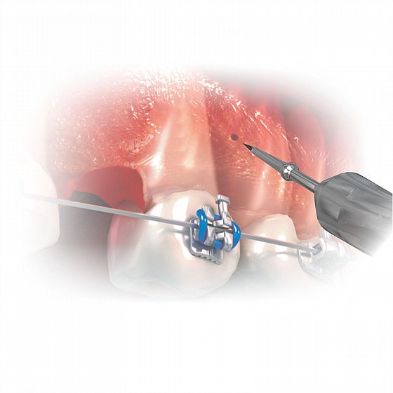 ��� ������ ����� ������ ���� ���� Morelli Distal Bender Open/Closed