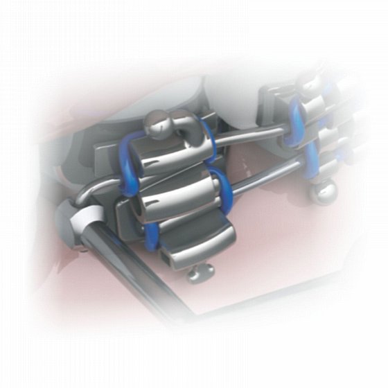 ��� ������ ����� ������ ���� ���� Morelli Distal Bender Open/Closed