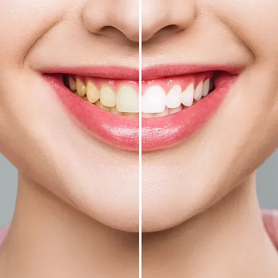 ������ ����� ������� 28 ������ White Pro - Whitening Strips