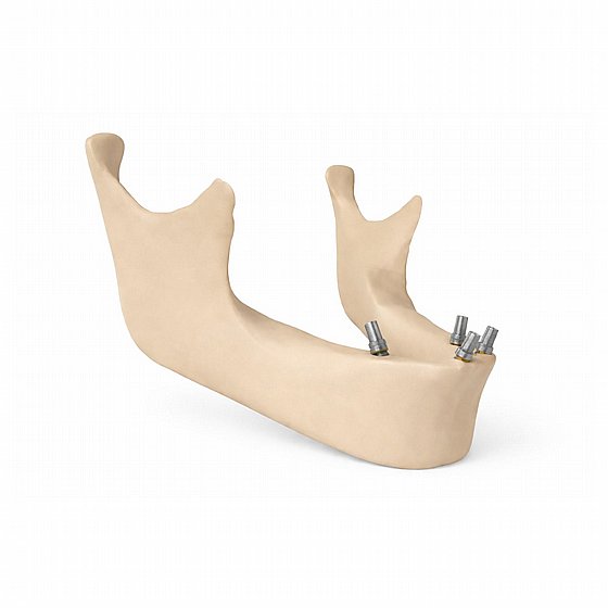 ��� ����� ������ ����� ���� ����� M1.72 ���� ���� DSI 3d Scan Body for Multi-Unit