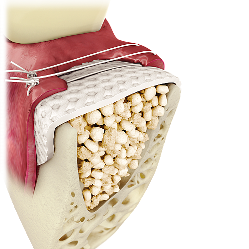 ������ d-PTFE ����� �� ����� ���� ������ Cytoplast� TXT-200 Non-Resorbable High-Density PTFE Membrane